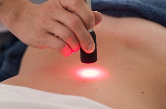 epilazione laser a diodi